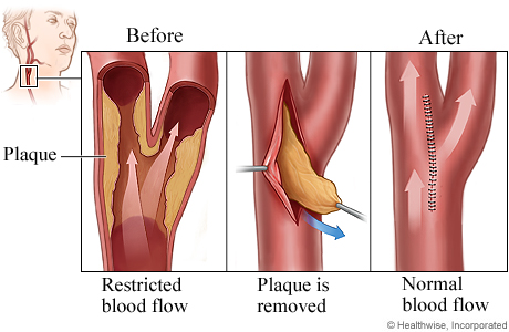 HVI Carotid endarterectomy